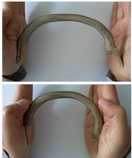 鈦合金將成過去式！我國實施國際首例3D打印PEEK肋骨植入術(shù)